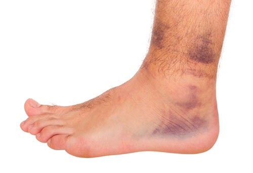ankle sprain 3