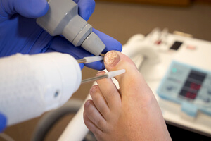 Laser Treatment for Fungal Toenails Photo 02