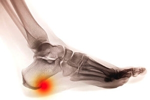 What Causes Plantar Fasciitis?