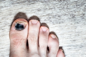 Causes of Blackened Toenails