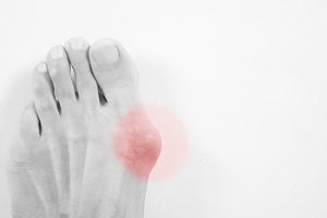 Where Is a Bunion Located?