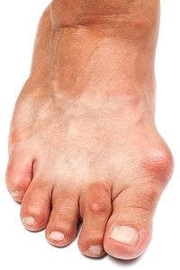 How Do Bunions Develop?