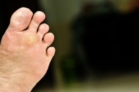 The Link Between HPV and Plantar Warts