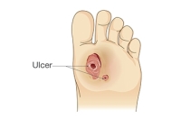 Causes of Foot Ulcers in Diabetic Patients