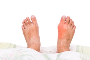 How Do Bunions Develop?