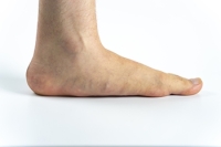 Causes of Flat Feet