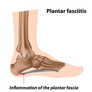 Stretches That May Relieve Heel Pain