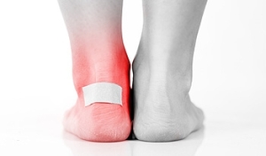 What Causes Blisters?