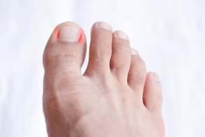 What Can Cause an Ingrown Toenail?