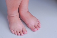 Causes and Treatment of Swollen Feet