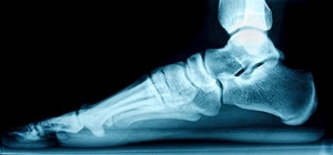 Are Flat Feet Hereditary?
