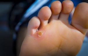 Complications Associated With Corns on the Feet