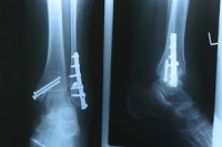 What Causes a Stress Fracture to Occur?