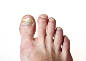 How Does Toenail Fungus Enter The Body?
