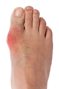 How Alcohol May Be Linked to Gout