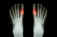 Joint Pain From Gout