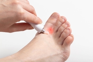 Anyone Can Get Athlete’s Foot
