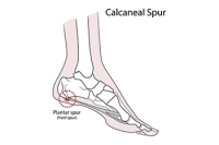 Pain Accompanied With a Heel Spur