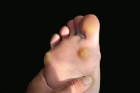 How Plantar Warts Are Different from Other Warts