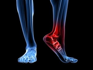 Types of Heel Pain