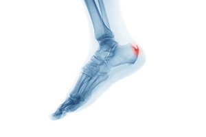 Dealing With Heel Spurs